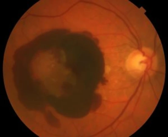 Hemo-intraocular-i-subretiniana