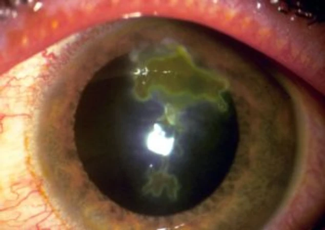 Herpes-ocular