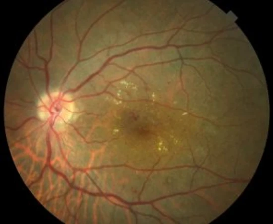 edema-macular