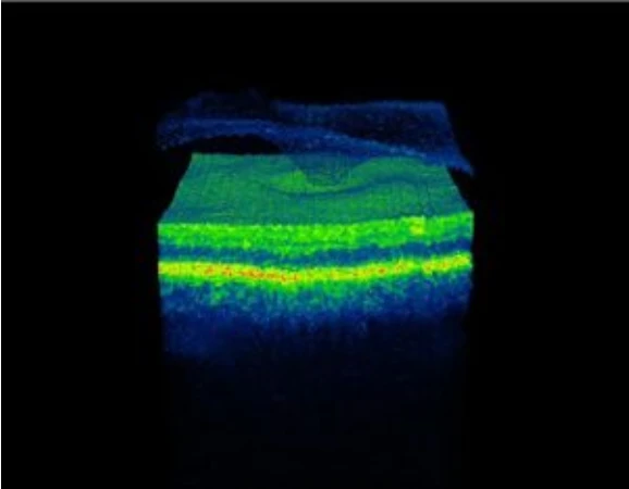 Sindrome-de-traccio-macular