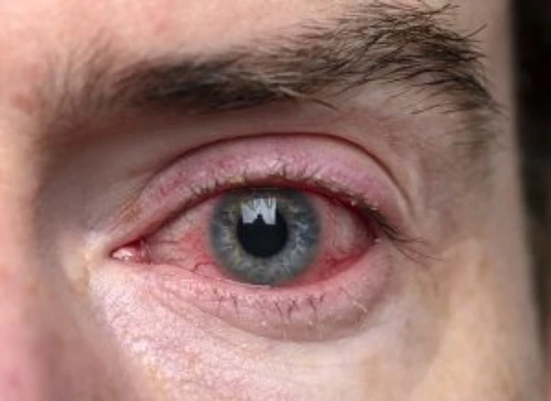 condicion-conjuntivitis-blefaritis-ocular